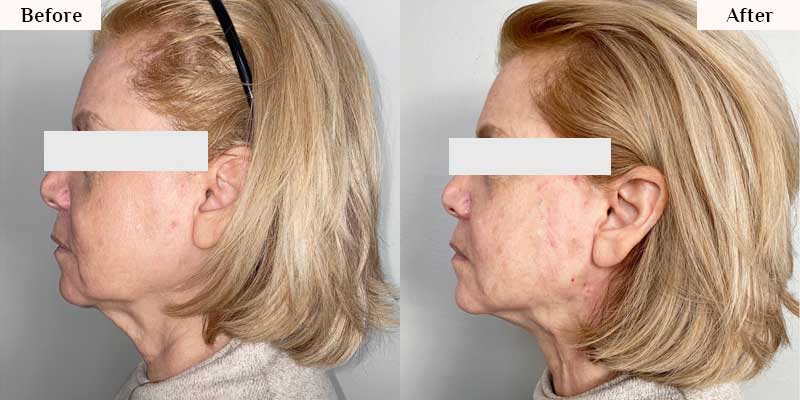 pdo thread lift before after